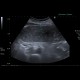 Carcinoma of transverse colon, ileus, perforation of bowel, peritonitis: US - Ultrasound